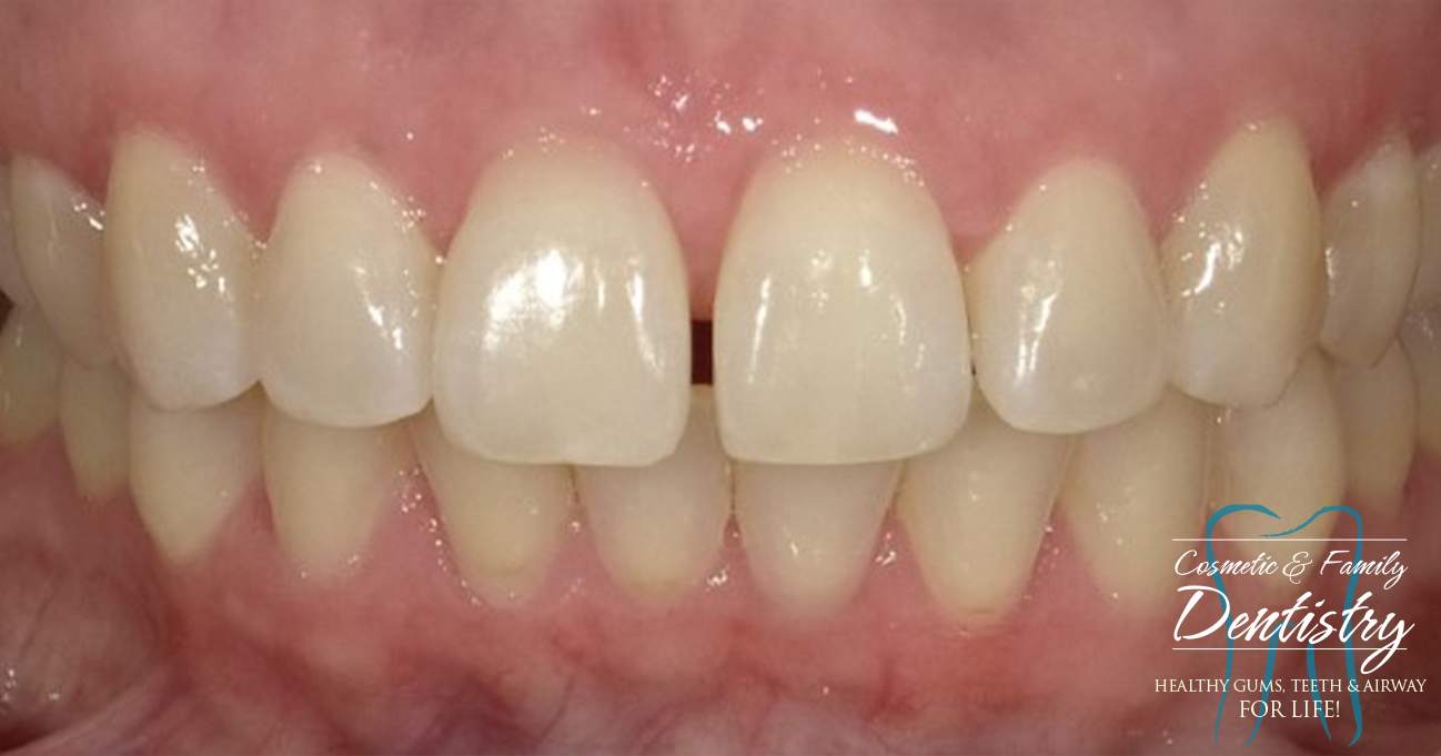 Close up of imperfect teeth before Bioclear dental bonding