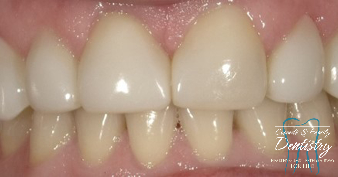 Close up of flawless smile after Bioclear dental bonding