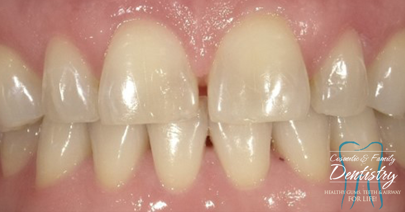 Close up of imperfect teeth before Bioclear dental bonding