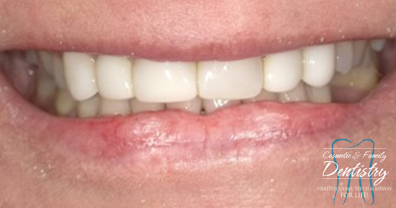 Close up of flawless smile after Bioclear dental bonding