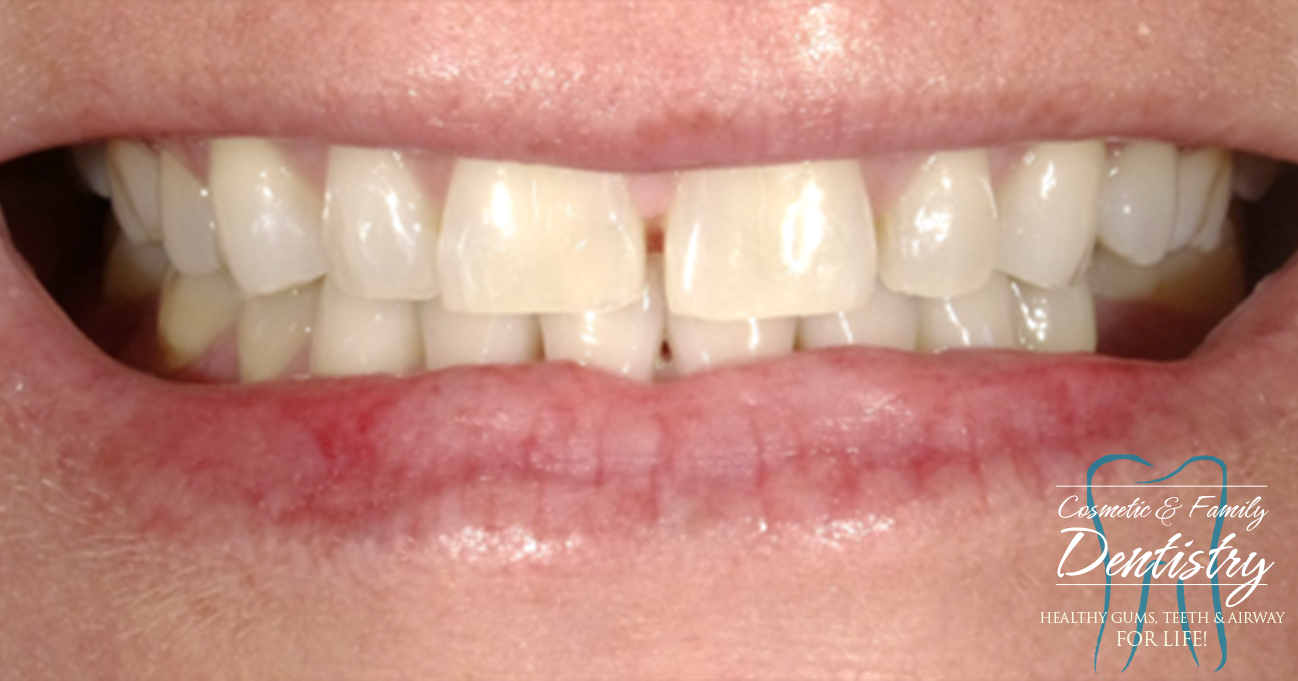 Close up of imperfect teeth before Bioclear dental bonding