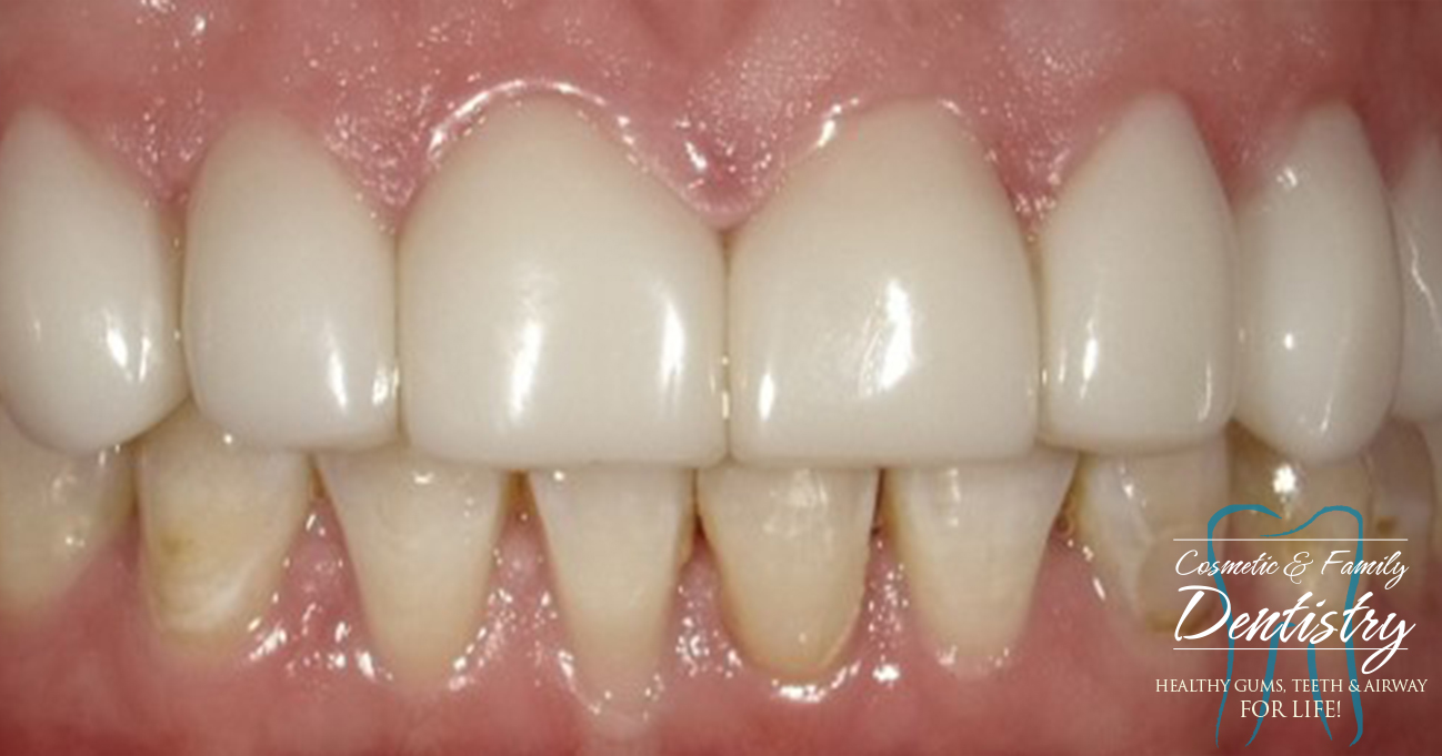 Close up of flawless smile after Bioclear dental bonding