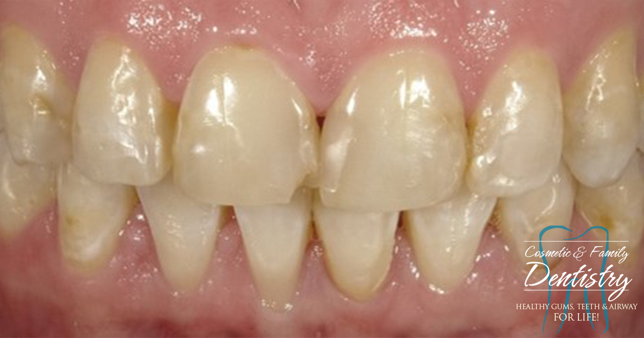 Close up of imperfect teeth before Bioclear dental bonding