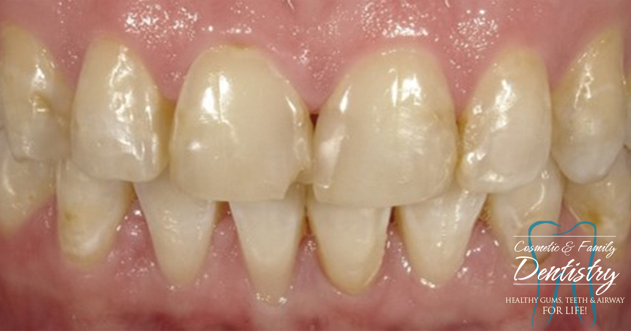 Close up of imperfect teeth before Bioclear dental bonding