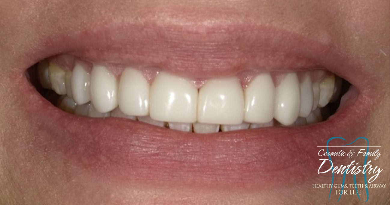 Close up of flawless smile after Bioclear dental bonding