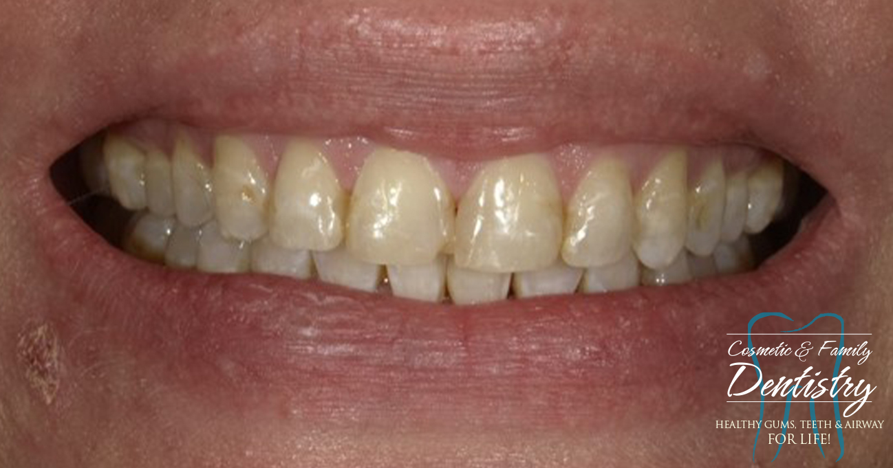 Close up of imperfect teeth before Bioclear dental bonding