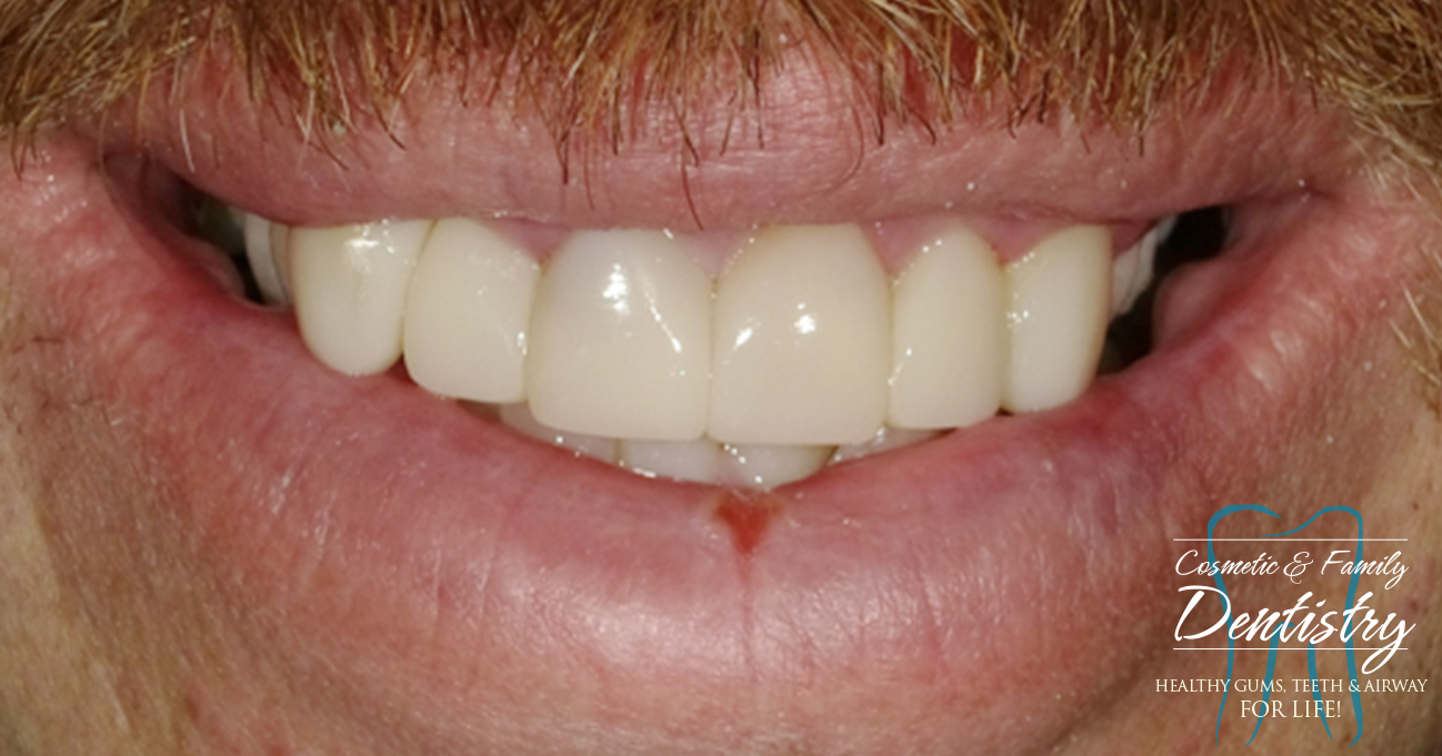 Close up of flawless smile after Bioclear dental bonding