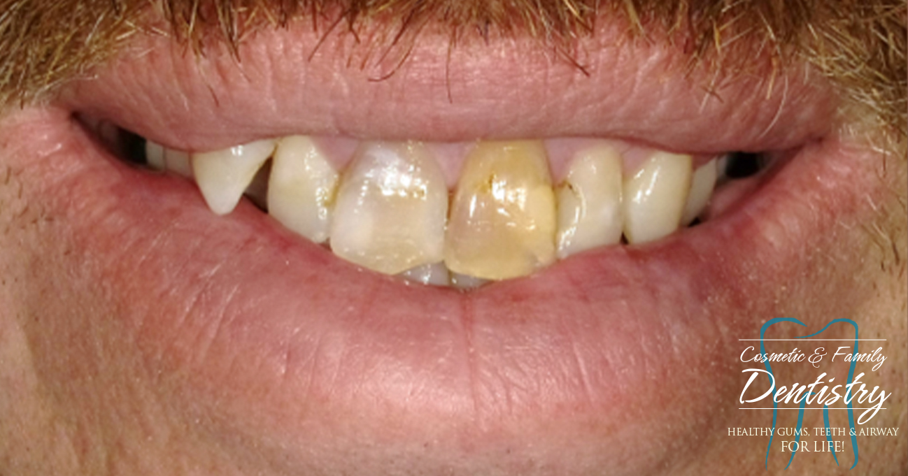 Close up of imperfect teeth before Bioclear dental bonding