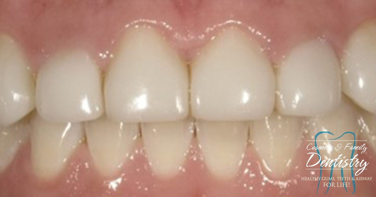 Close up of flawless smile after Bioclear dental bonding