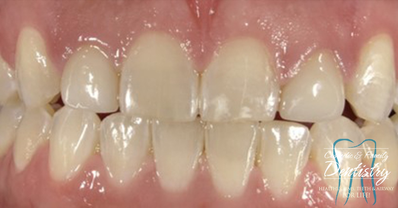 Close up of imperfect teeth before Bioclear dental bonding