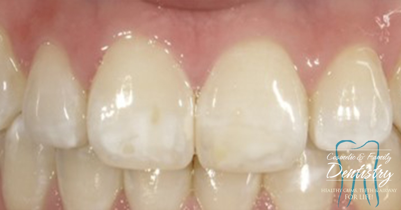 Close up of imperfect teeth before Bioclear dental bonding