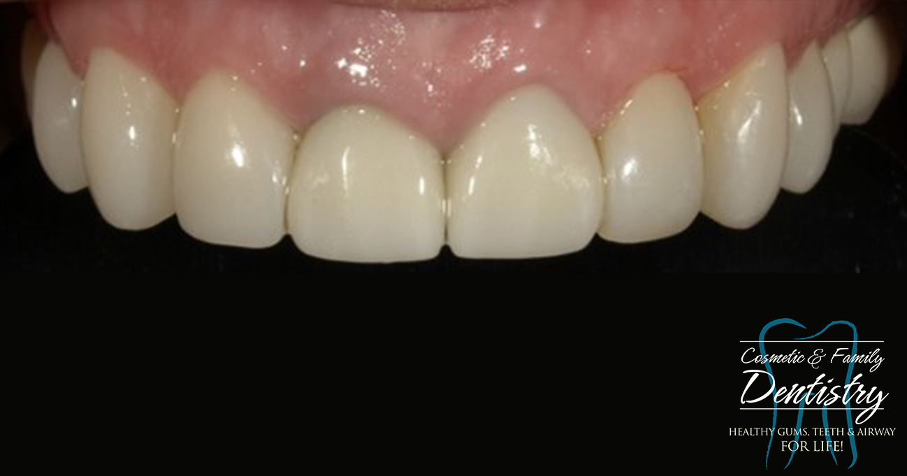 Close up of flawless smile after Bioclear dental bonding