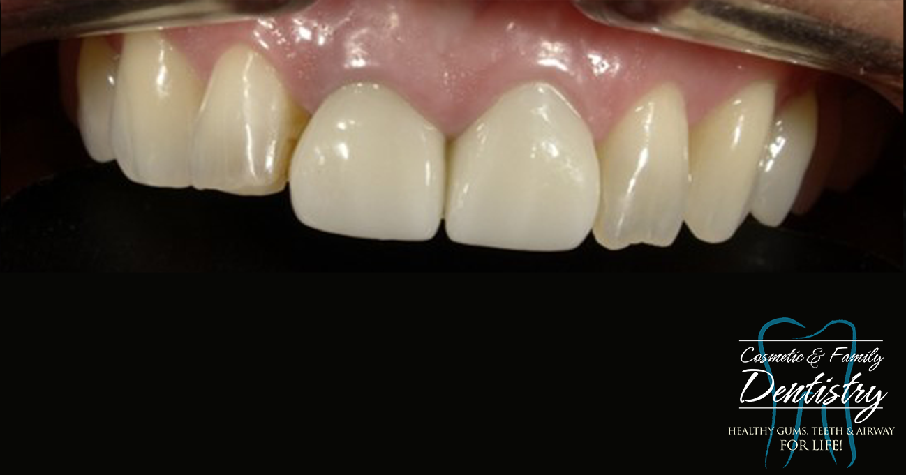 Close up of imperfect teeth before Bioclear dental bonding