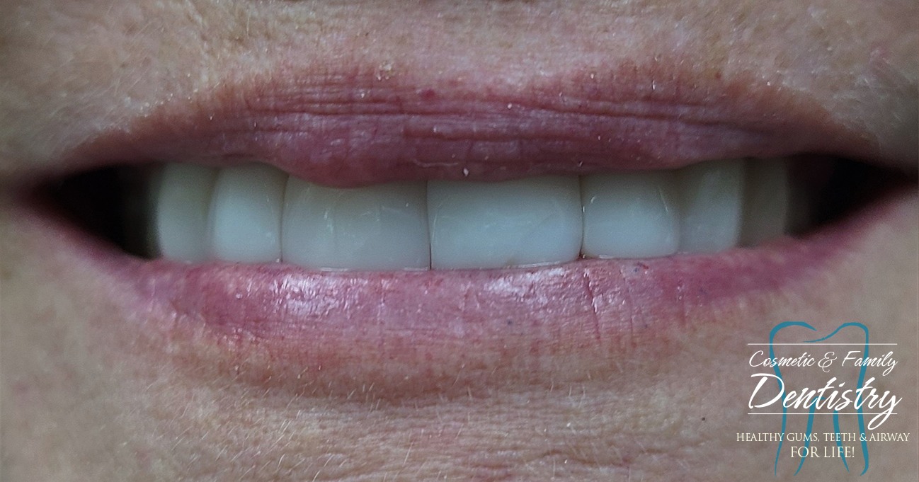 Close up of flawless smile after Bioclear dental bonding