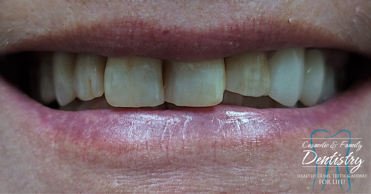 Close up of imperfect teeth before Bioclear dental bonding