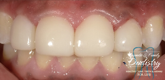 Close up of flawless smile after Bioclear dental bonding