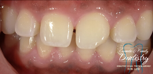 Close up of imperfect teeth before Bioclear dental bonding