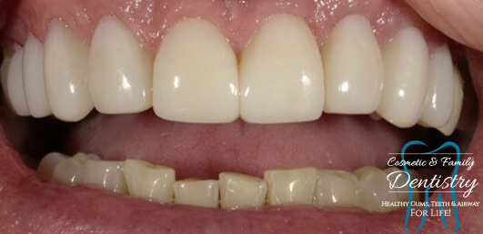 Close up of flawless smile after Bioclear dental bonding