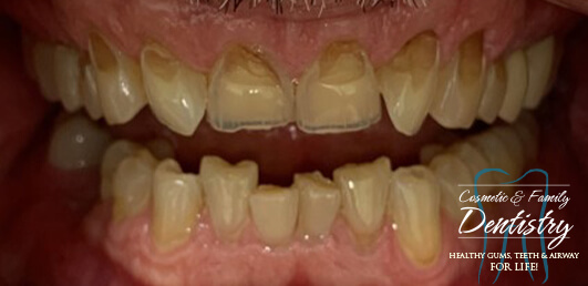 Close up of imperfect teeth before Bioclear dental bonding