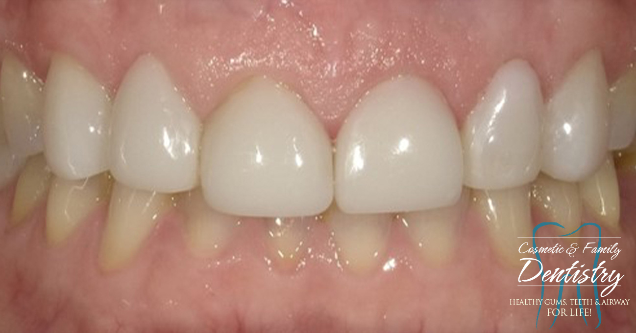 Close up of flawless smile after Bioclear dental bonding