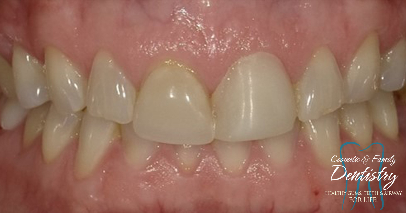 Close up of imperfect teeth before Bioclear dental bonding