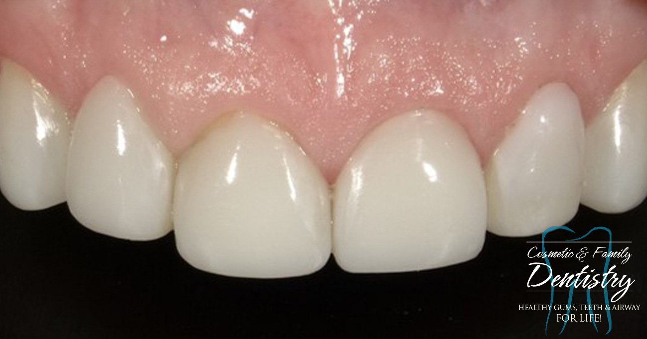 Close up of flawless smile after Bioclear dental bonding