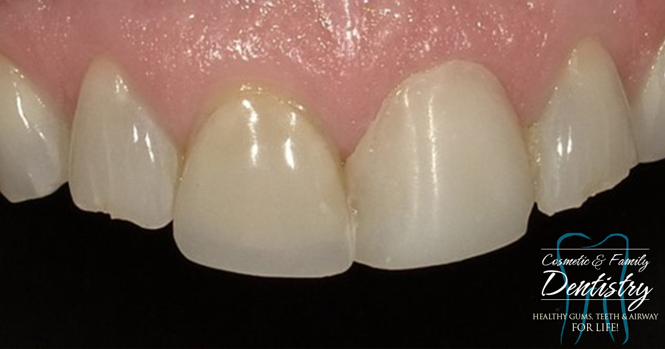 Close up of imperfect teeth before Bioclear dental bonding