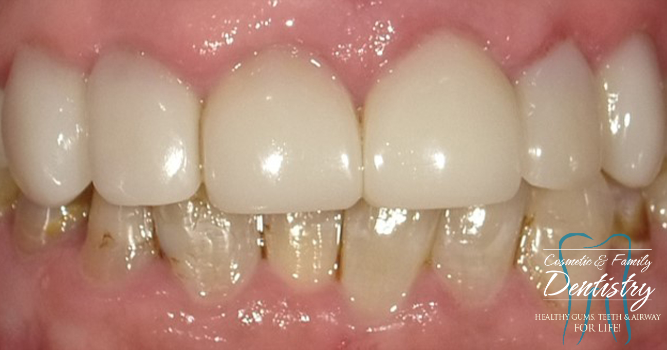 Close up of flawless smile after Bioclear dental bonding