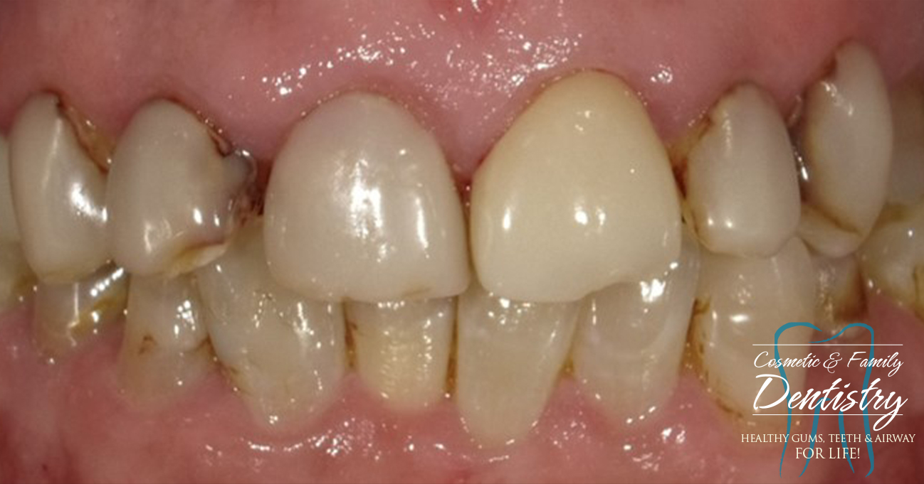 Close up of imperfect teeth before Bioclear dental bonding