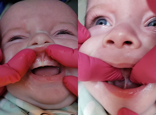 Close up of infant smiling after lip and tongue tie treatment in Weatherford