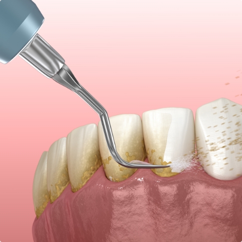 Illustrated dental tool removing plaque buildup from teeth