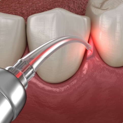 Illustrated soft tissue laser treating diseased gums