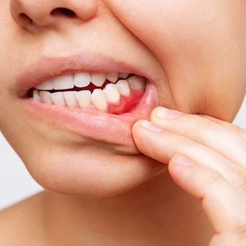 Closeup of patient with red gums