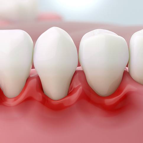 Illustration of red, inflamed gums