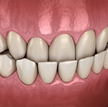 a 3 D illustration of an underbite