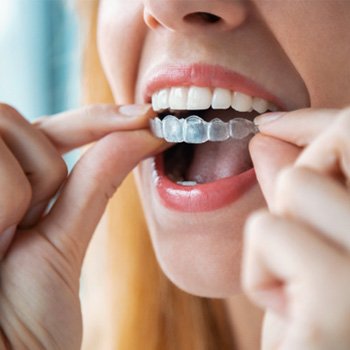 closeup of an Invisalign aligner being put in