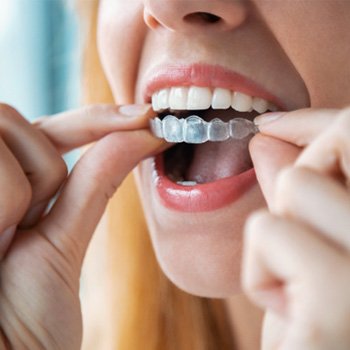 closeup of Invisalign aligner being put in 