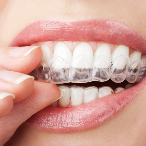 Close up of person placing an Invisalign clear aligner in Weatherford in their mouth