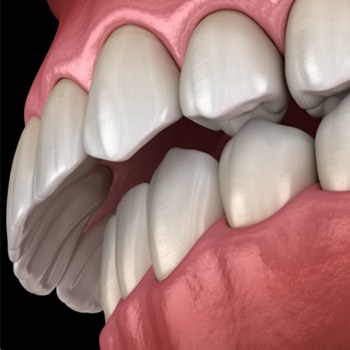 Illustrated mouth with overbite