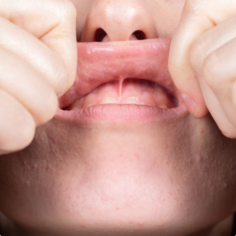 Close up of person lifting up their upper lip