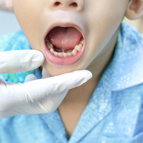 Child opening their mouth wide in dental office