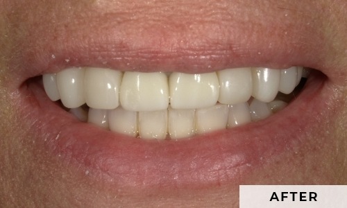 smiling patient
