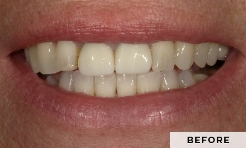 smiling patient