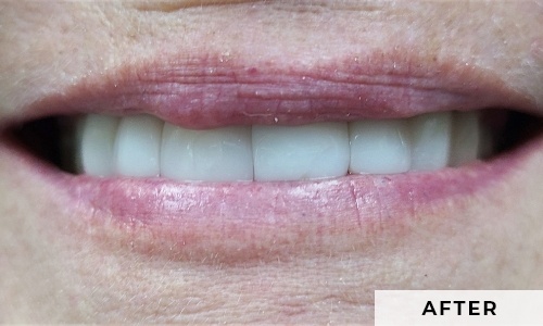 smiling patient