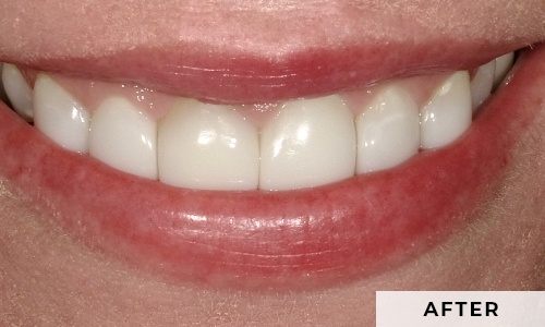 smiling patient