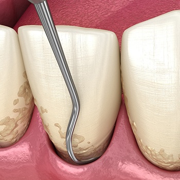 Closeup rendering of dental instrument scooping plaque out of the pockets of gums