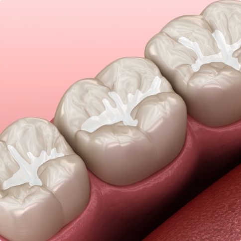 Illustrated teeth with barely noticeable tooth colored fillings