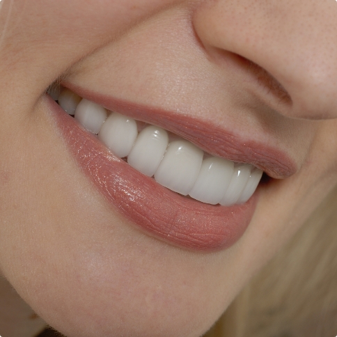 Close up of woman smiling with straight white teeth after restorative dentistry