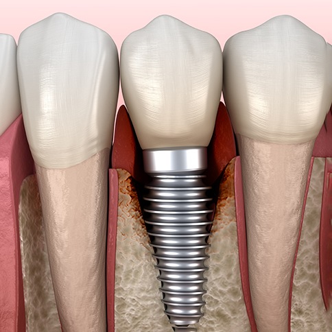 Illustration of a failed dental implant in Weatherford in the jawbone jawbone