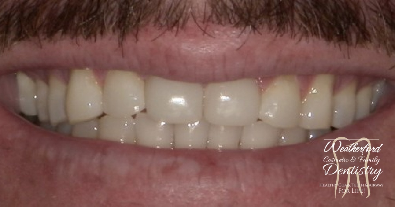 Close up of flawless smile after Bioclear dental bonding